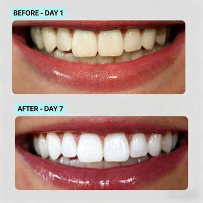 Premium Teeth Whitening Black SPA Kit for Home Use