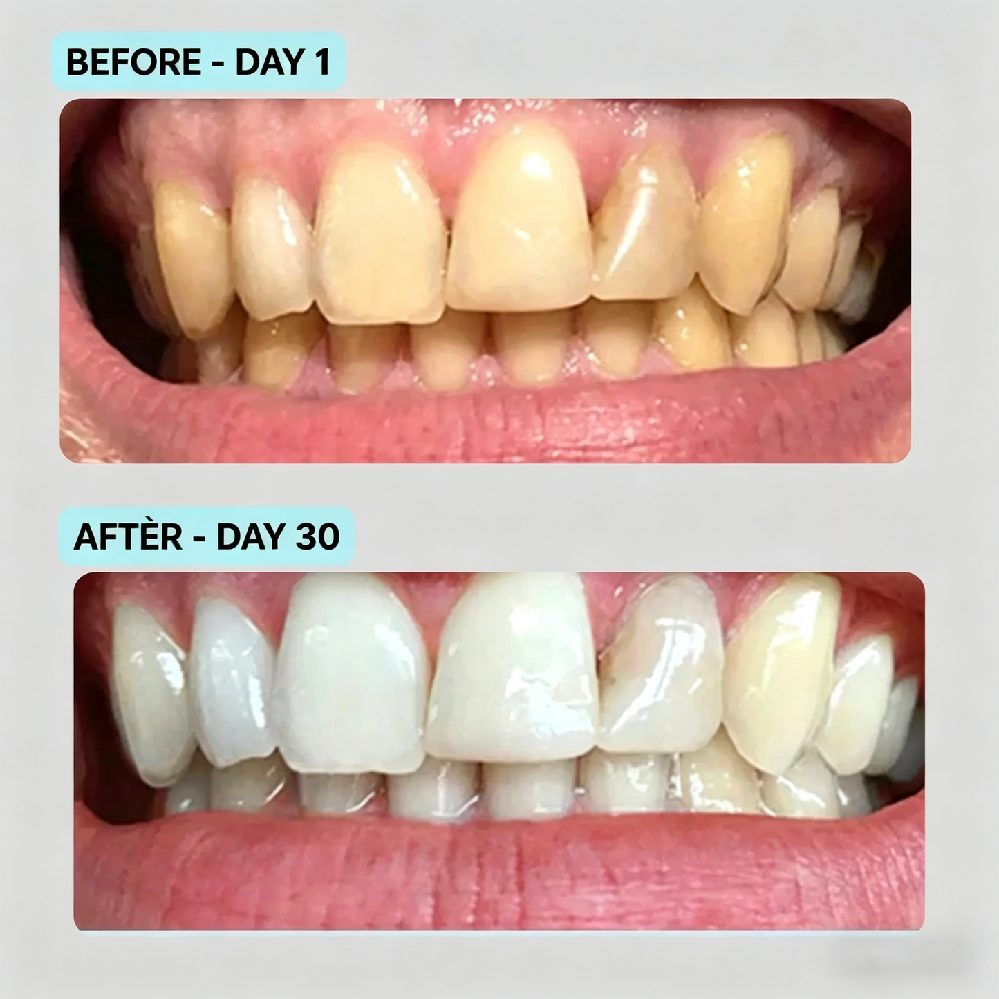 Premium Teeth Whitening Black SPA Kit for Home Use