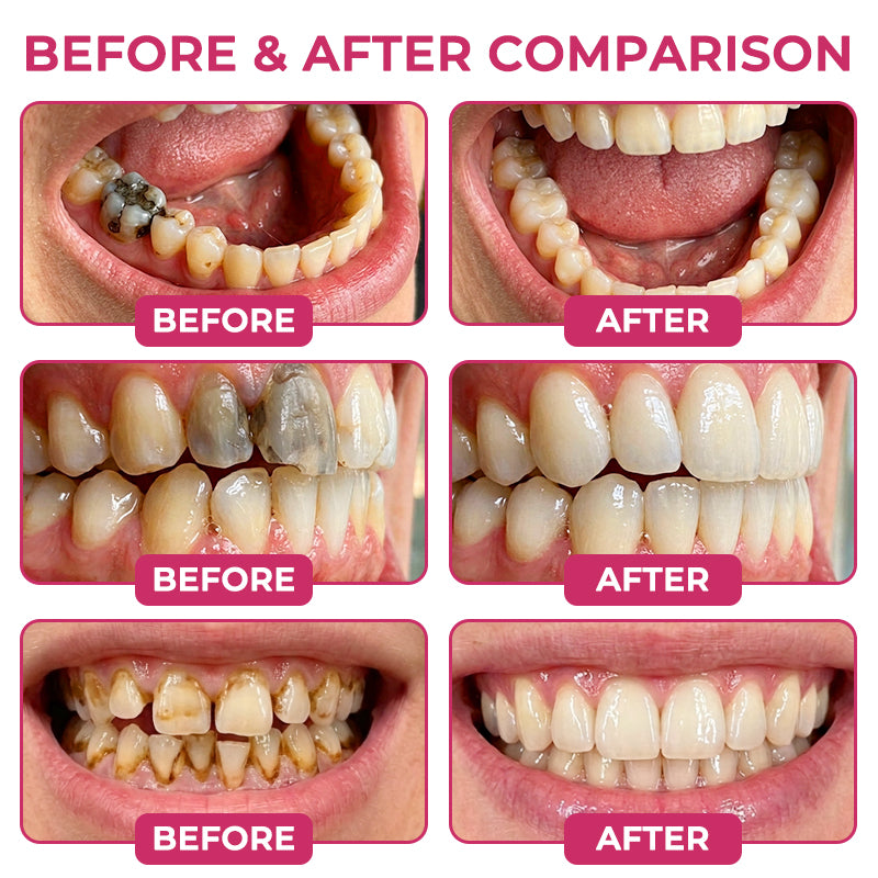Rolimey® DenPerm Natural Enamel Restoration Gel – Cavity & Micro-Crack Repair