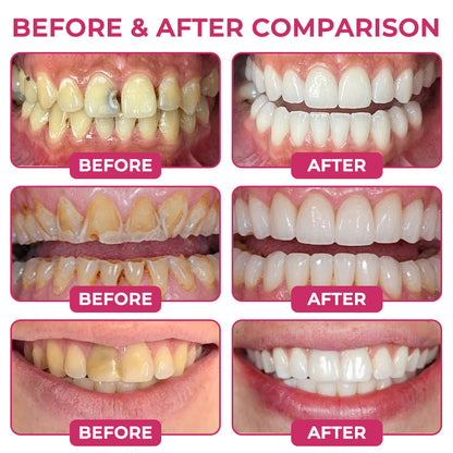 Rolimey® DenPerm Natural Enamel Restoration Gel – Cavity & Micro-Crack Repair
