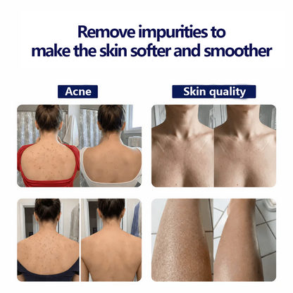 🔥 BUY 1 GET 1 FREE 🔥 Exfoliating Antibacterial Shower Towel