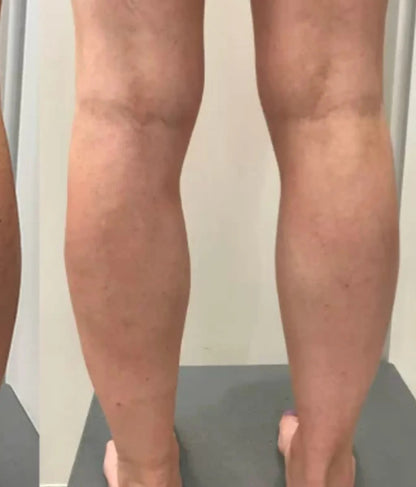 C-Varicose Vein Cream