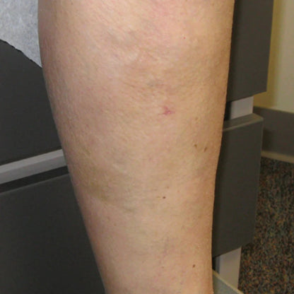 C-Varicose Vein Cream